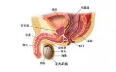 什么是前列腺钙化？