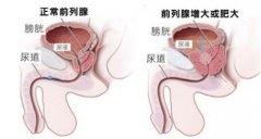 患了前列腺肥大该如何护理保健