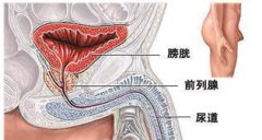 不要被前列腺钙化欺骗